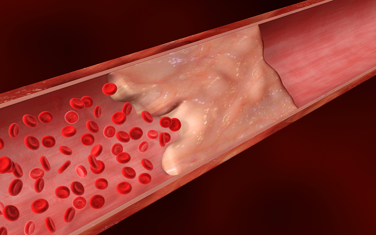 Bloc cardiaque : 7 conseils approuvés par les cardiologues pour maintenir la propreté des artères et une circulation sanguine plus fluide